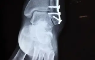 bone plate and screws - common broken bone for airline workers and bike messangers