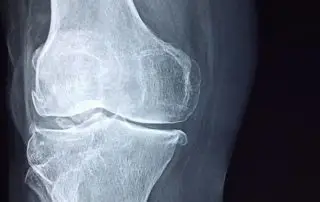 x-ray of the knee of forklift operator