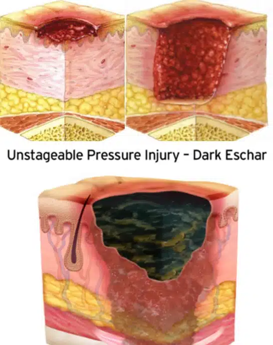 pressure ulcer